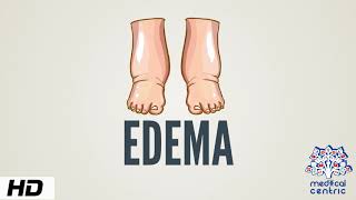 Edema Causes Signs and Symptoms Diagnosis and Treatment [upl. by Voorhis872]