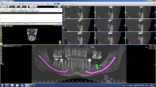 Implant PLanning with Acteon Imaging Suite CBCT Cone Beam part 2 [upl. by Oiredised]