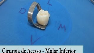 Molar Inferior  Cirurgia de Acesso [upl. by Joslyn954]