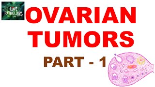 OVARIAN TUMORS  Part 1  Classification [upl. by Basset]