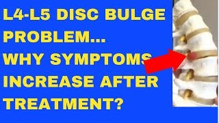 Why Does L4 L5 Disc Bulge Symptom Increase After Treatment  Answered by Chiropractor in Vaughan [upl. by Inalem]