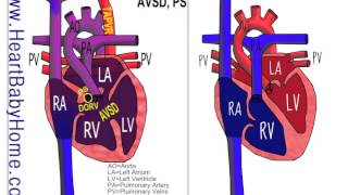 25  Total Anomalous Pulmonary Vein Return TAPVR with DORV AVSD ps [upl. by Nimsay889]