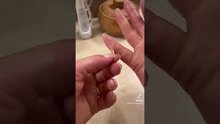 Finger peeling with palmoplantar keratoderma hand callus EPPK  Apr 8 2023 [upl. by Bowler]