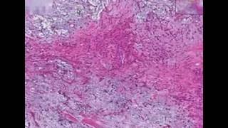 Histopathology Salivary glandPleomorphic adenoma mixed tu [upl. by Ayres]