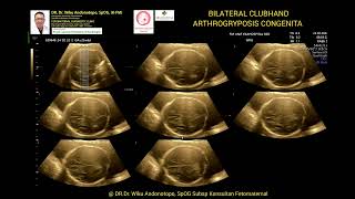 Arthrogryposis congenita 23 weeks [upl. by Alisan]