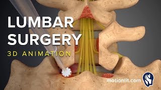 Lumbar Surgery  Laminectomy  3D Medical Animation [upl. by Rikki]