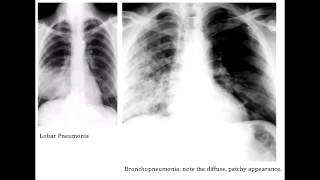 Lobar Pneumonia amp Bronchopneumonia  Organisms amp Characteristics [upl. by Fitton]