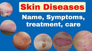 skin diseases  skin disease namepicture symptoms treatment  live Nursing class [upl. by Fabrienne]