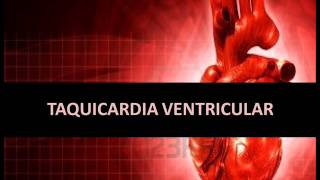 Arritmias cardíacas  Taquicardia ventricular [upl. by Natika]