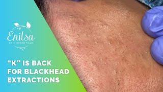 K Is Back for Blackhead Extractions [upl. by Nitsud]