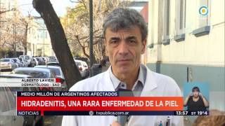 TV Pública Noticias  Hidradenitis una rara enfermedad de la piel [upl. by Akihsay]