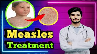 How to treat Measles quickly  Measles Treatment step by step [upl. by Docile198]