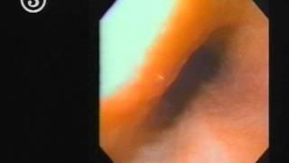 TOP 14 Part 1 Flexible Endoscopy [upl. by Therese945]