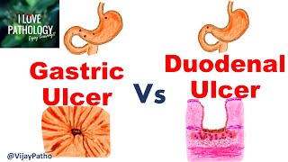 Peptic Ulcer Disease GASTRIC VS DUODENAL ULCERS [upl. by Osi]