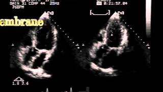 subaortic membrane and mild aortic regurgitation 12 [upl. by Bettina]