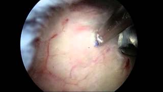 Arthroscopic removal of calcium deposit from shoulder calcific tendonitis [upl. by Skoorb626]