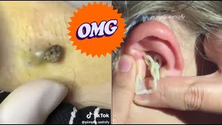 Blackhead Popping Extravaganza Satisfying Skin Care Moments [upl. by Orlantha19]