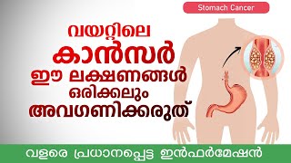 വയറ്റിലെ കാൻസർ ഈ 4 ലക്ഷണങ്ങൾ ഒരിക്കലും അവഗണിക്കരുത്  വളരെ പ്രധാനപ്പെട്ട ഇൻഫർമേഷൻ  Stomach cancer [upl. by Acinej]