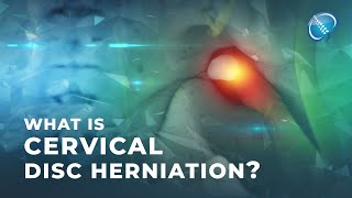 What is Cervical Disc Herniation  Herniated Disc [upl. by Amimej]