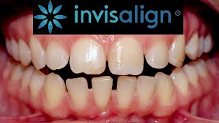 INVISALIGN time lapse Treatment of 7 MONTHS Incisor proclination [upl. by Spiros]