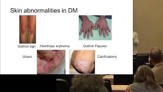 Diagnosing Myositis Marianne de Visser MD [upl. by Eenobe]