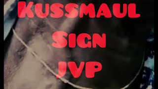 Kussmaul sign on clinical examination Explained  Jugular Venous Pressure [upl. by Huan]