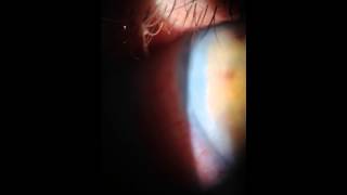 Corneal Edema [upl. by Suivatnod540]