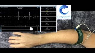 Needle EMG demonstration [upl. by Savil]