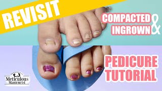 Revisiting the Deep Compacted Ingrown Toenail [upl. by Hahseram]