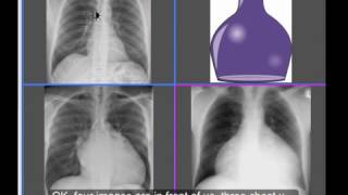 Chest xray  Cardiomegaly or No Cardiomegaly  water bottle sign [upl. by Atsirak]