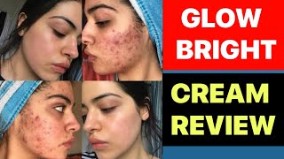 melasma treatment cream in hindi  acne removal cream  pimples ka cream [upl. by Alysia]