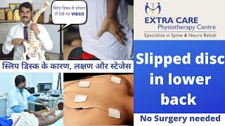 Slipped Disc in Lower Back  स्लिप डिस्क के कारण लक्षण और स्टेजेस [upl. by Drooff]