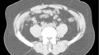 Ureteral Stone with Obstruction DISCUSSION by a Radiologist [upl. by Kan911]