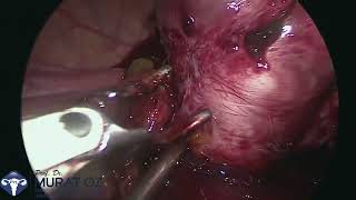 Difficult Laparoscopic Myomectomy in a Patient With Endometriosis [upl. by Dogs]