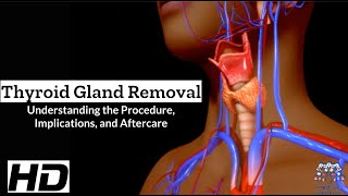 Thyroid Surgery Explained What They Dont Always Tell You [upl. by Ellerrad]