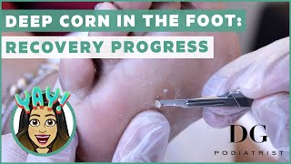 Deep corn in the foot Recovery progress [upl. by Lewls]