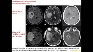 62 Glioblastoma versus astrocytoma IDHmutant grade 4 GBM prognosis different TME immunotherapy [upl. by Havard899]