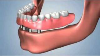 edentulismo completo opciones fija total sobredentaduraflv [upl. by Drandell]