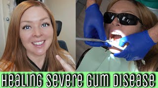 My Experience With SEVERE Gum Disease Periodontal disease diagnoses treatments amp natural healing [upl. by Ahtelra851]