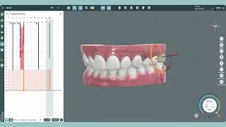 Overcorrection  Dental Software for Overcorrection Aligners [upl. by Allevon]