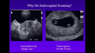 Sonography of Twins [upl. by Mechelle]