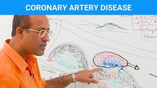 Coronary Angiography  NEJM [upl. by Goldfinch108]