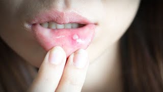 Mouth Ulcer Treatment urdu hindi Irfan Azeem YouTubeShorts [upl. by Annairoc]