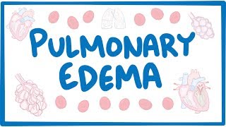 Pulmonary Edema  causes symptoms diagnosis treatment pathology [upl. by Eelamme683]