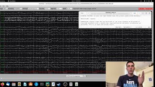 EEG Record Review of 23 Year Old With Primary Generalized Epilepsy [upl. by Blair]