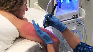 Dermalinfusion for KP Keratosis Pilaris [upl. by Naawaj]