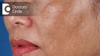 Treatment of Melasma  Dark Spots on Face  Dark patch on face  Dr Satish D A  Doctors Circle [upl. by Nohsar]