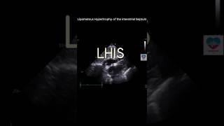 Lipomatous Hypertrophy of Interatrial Septum echocardiography 심장초음파 heart sonography tte [upl. by Au]