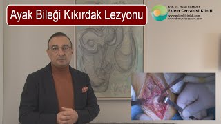 Ayak Bileği Kıkırdak Lezyonu [upl. by Yesllek862]