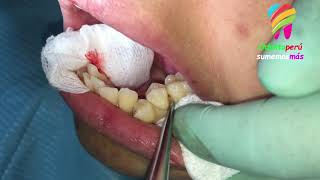 🔥 ECTOPIC canines and MIDLINES shifting  four premolars extraction case HOW BRACES WORK TIMELAPSE [upl. by Erdman]